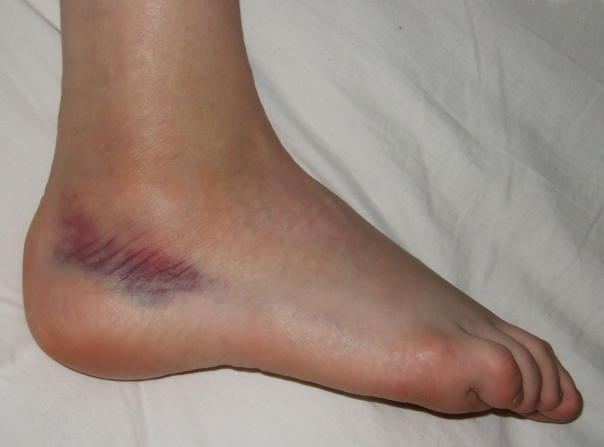 ankle sprain