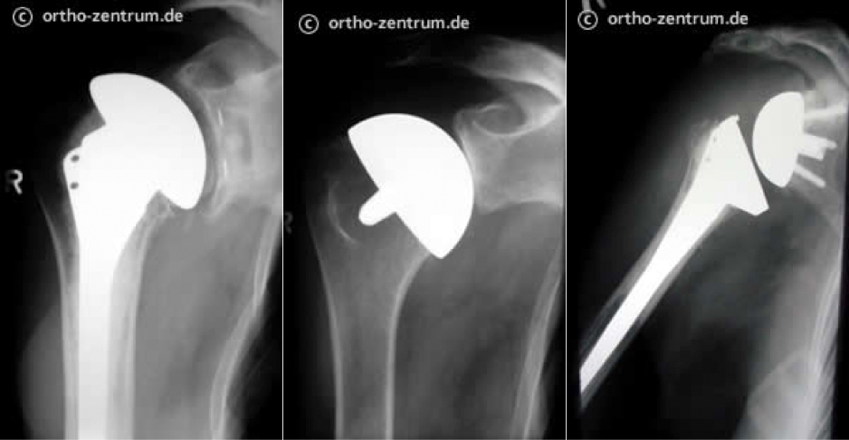 Röntgenbild Endoprothesetypen des Schultergelenkes