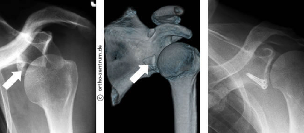 Schultergelenksverrenkung Röntgenbild