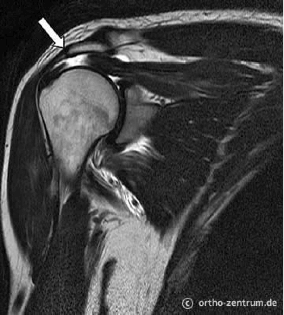 Rotatorenmanschette im MRT (Kernspintomographie)