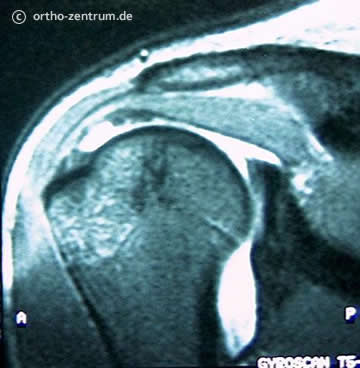 Bild Kernspintomographie Kapsel des Schultergelenkes