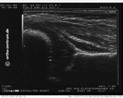 Ultraschallbild einer Hüfte eines 6 Wochen alten gesunden Kindes