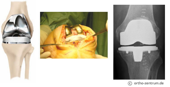 Ortho-Zentrum | Orthopädie und Unfallchirurgie - Knieendoprothesen