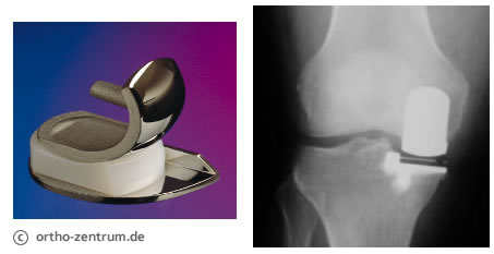 Schlittenprothese bei einseitiger Gonarthrose