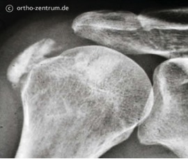 Kalkeinlagerung Tendinosis calcarea